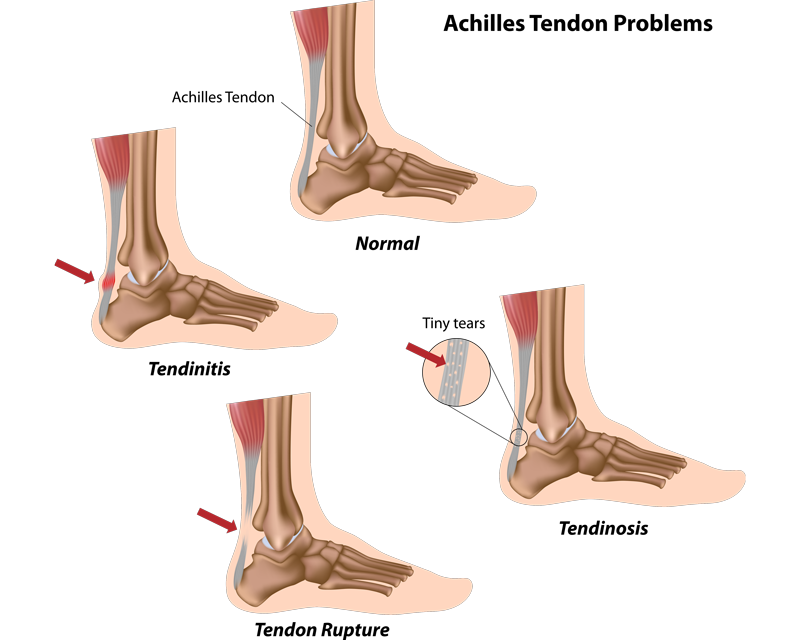 Achilles Tendonitis
