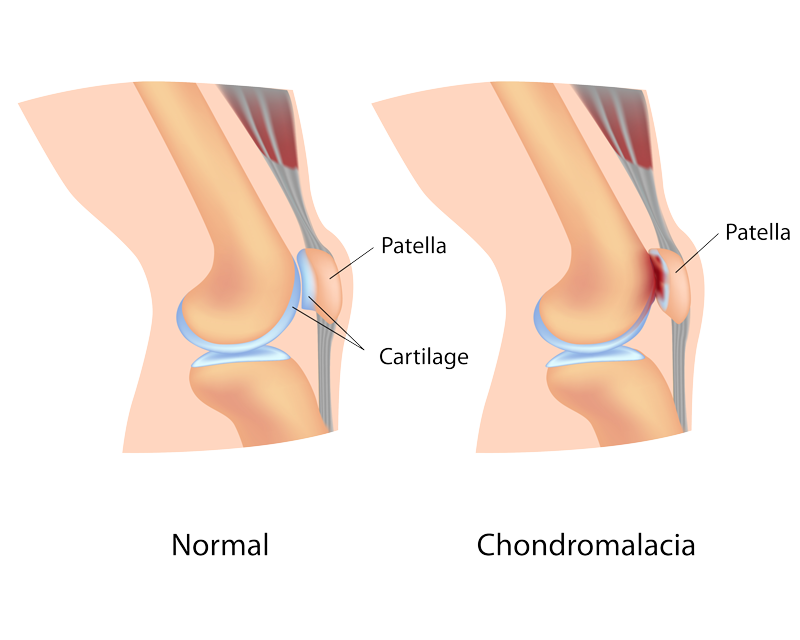 Chondromalacia Patella