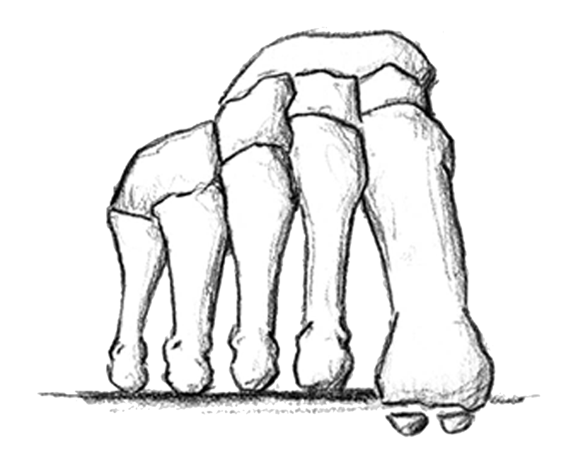 Dropped Metatarsal Head
