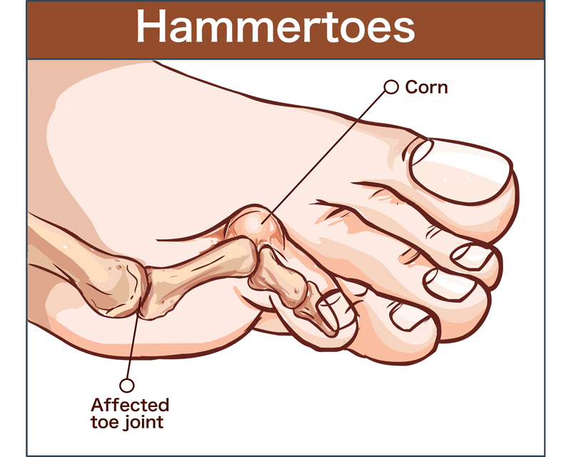 Hammer Toes
