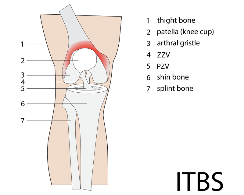 Iliotibial Band Syndrome (ITBS) “Friction Syndrome”