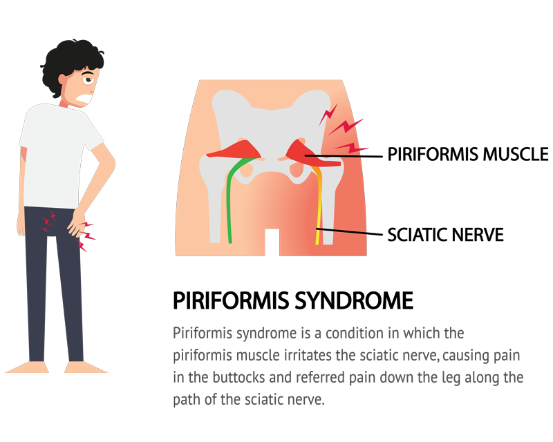 Piriformis Syndrome