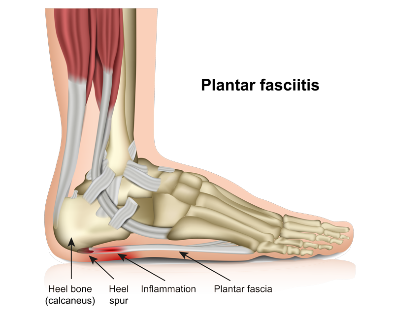 Plantar Fasciitis “Heel Spur Syndrome”